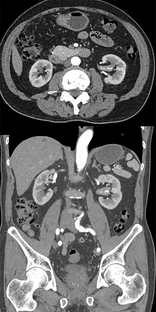 Transitional Cell Carcinoma of the Kidneys