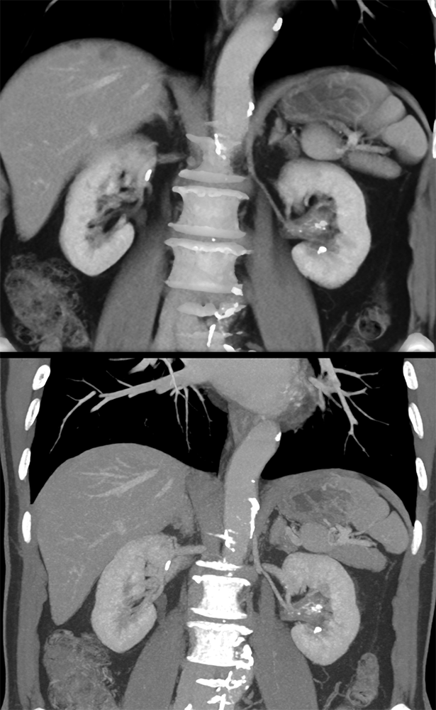 Transitional Cell Carcinoma of the Kidneys