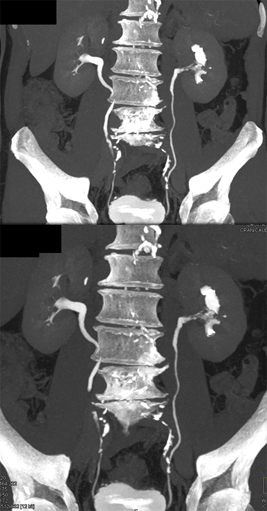 Transitional Cell Carcinoma of the Kidneys