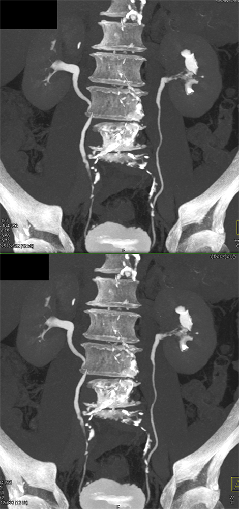 Transitional Cell Carcinoma of the Kidneys