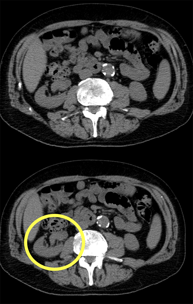 TCC Kidney: Focal Mass in Pelvis