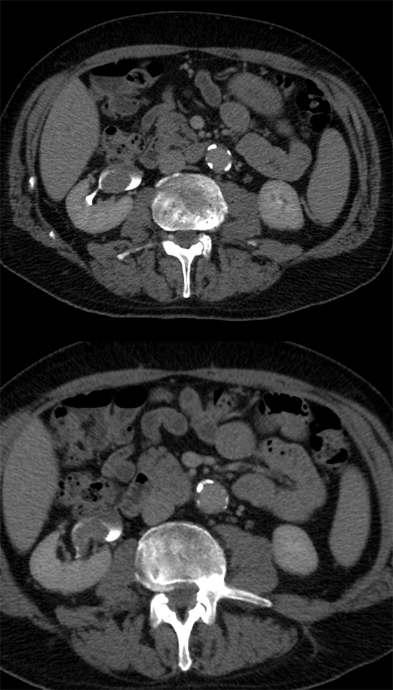 Transitional Cell Carcinoma of the Kidneys