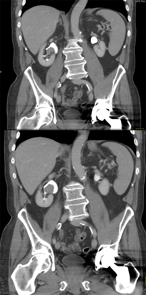 Transitional Cell Carcinoma of the Kidneys