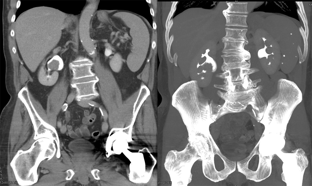 Transitional Cell Carcinoma of the Kidneys