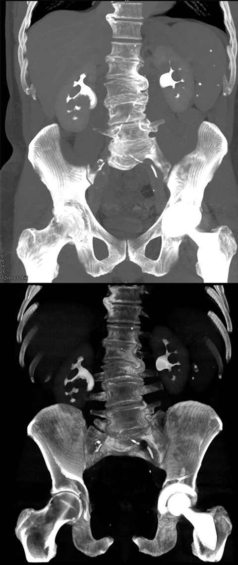 Transitional Cell Carcinoma of the Kidneys