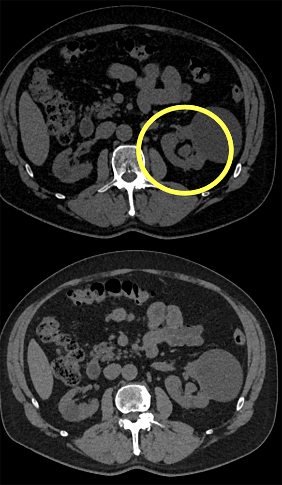 TCC Left Renal Pelvis