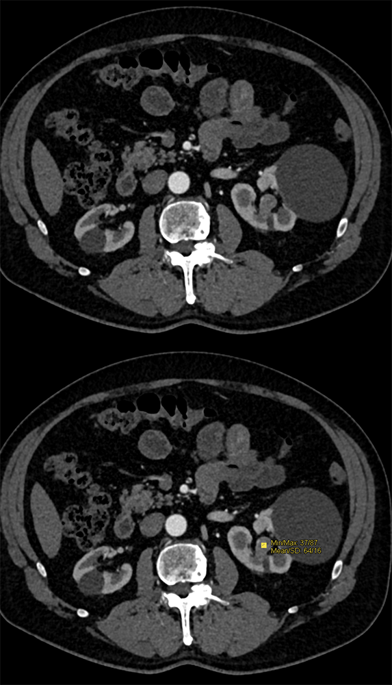 Transitional Cell Carcinoma of the Kidneys