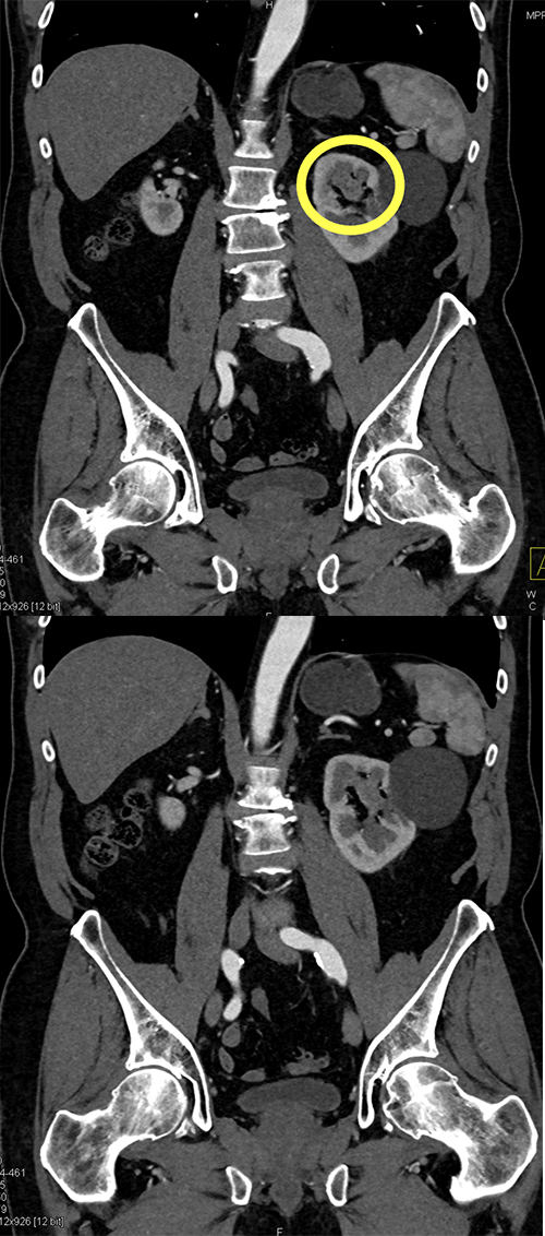 Transitional Cell Carcinoma of the Kidneys