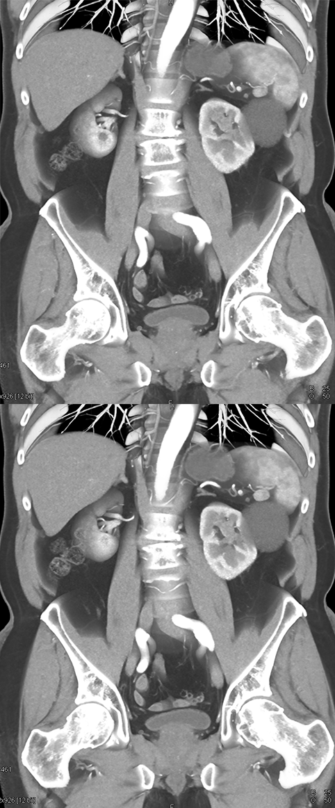 Transitional Cell Carcinoma of the Kidneys