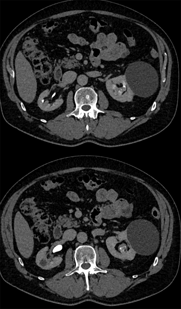 Transitional Cell Carcinoma of the Kidneys