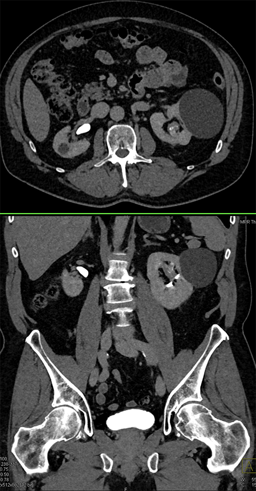 Transitional Cell Carcinoma of the Kidneys