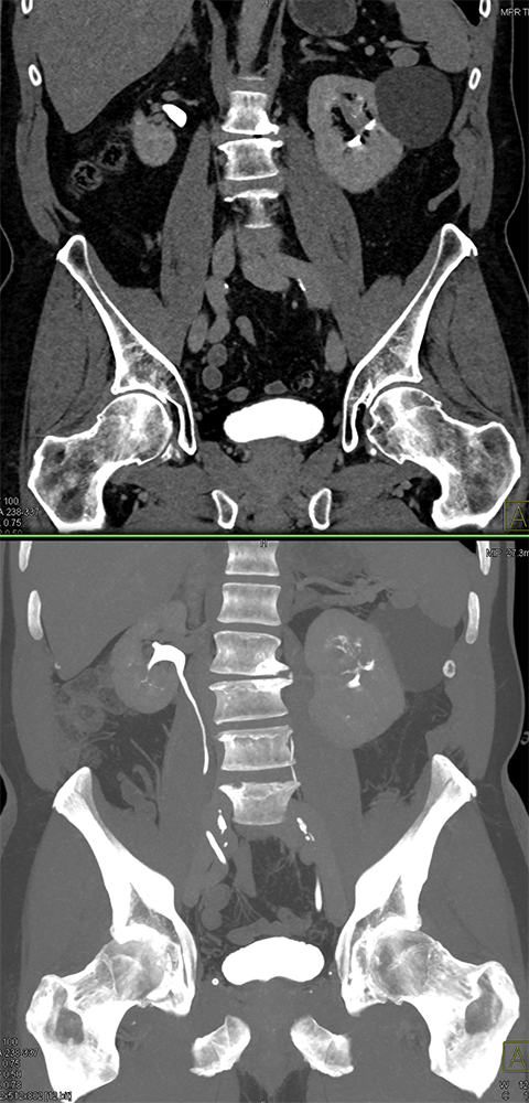 Transitional Cell Carcinoma of the Kidneys