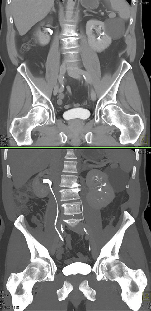 Transitional Cell Carcinoma of the Kidneys