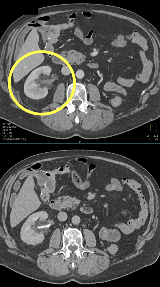 Hematuria and History of TCC