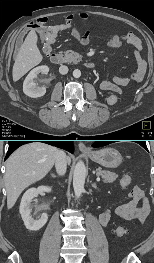 Transitional Cell Carcinoma of the Kidneys