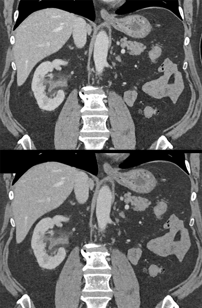 TCC Kidney