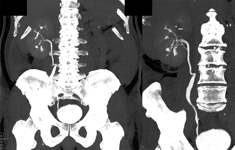 Transitional Cell Carcinoma of the Kidneys