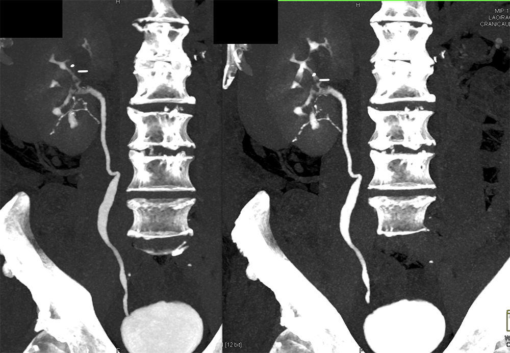 Transitional Cell Carcinoma of the Kidneys