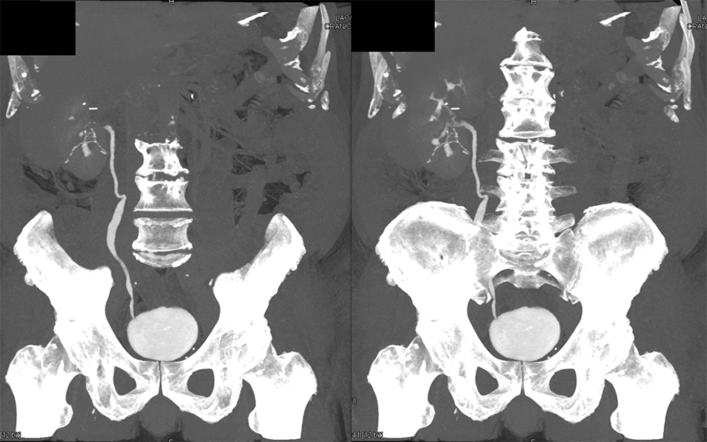 Transitional Cell Carcinoma of the Kidneys