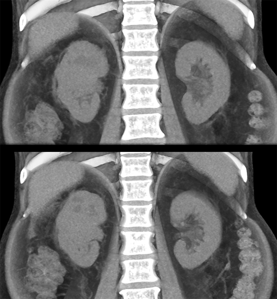 Hematuria