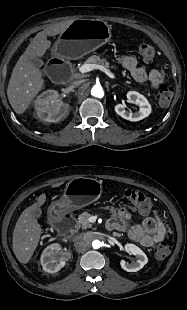 TCC Right Kidney: Infiltrative Mass