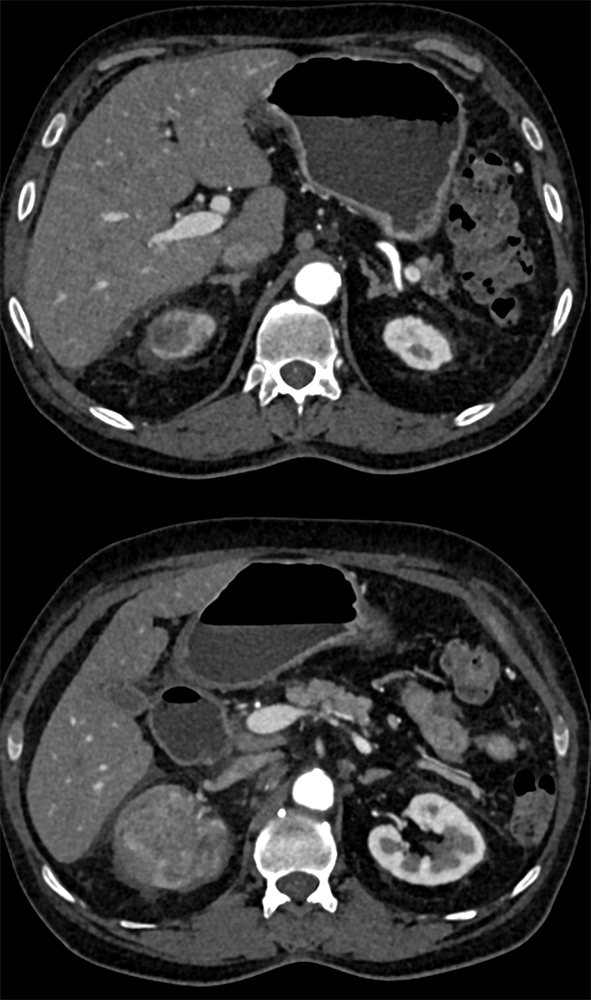 Transitional Cell Carcinoma of the Kidneys