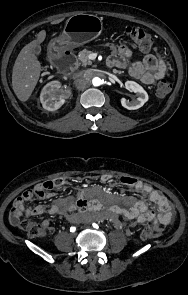 Transitional Cell Carcinoma of the Kidneys