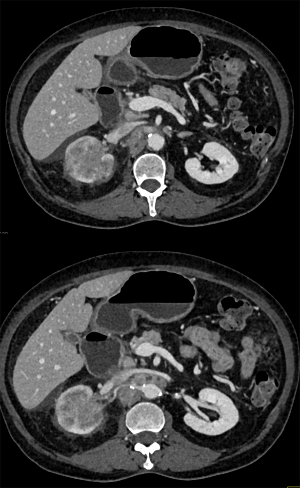 Transitional Cell Carcinoma of the Kidneys