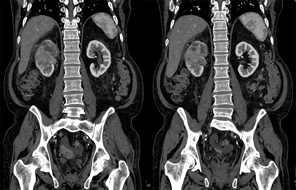 Transitional Cell Carcinoma of the Kidneys