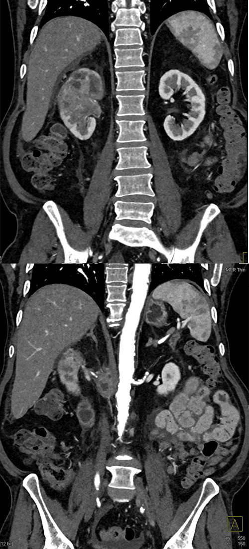 Transitional Cell Carcinoma of the Kidneys