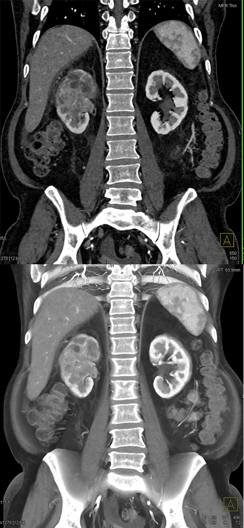 Transitional Cell Carcinoma of the Kidneys