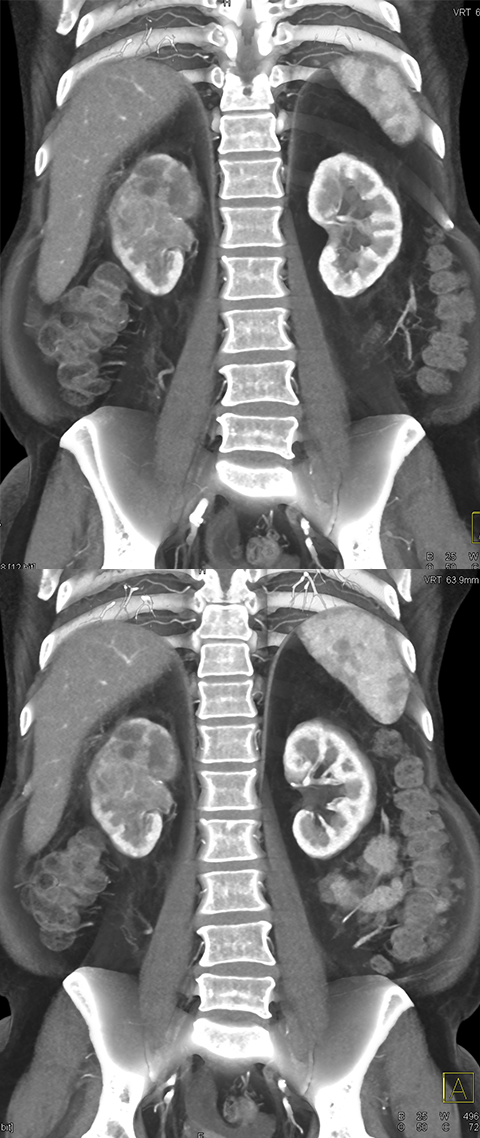 Transitional Cell Carcinoma of the Kidneys