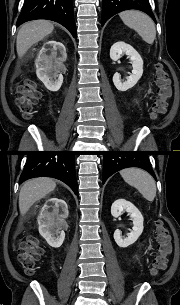 Transitional Cell Carcinoma of the Kidneys