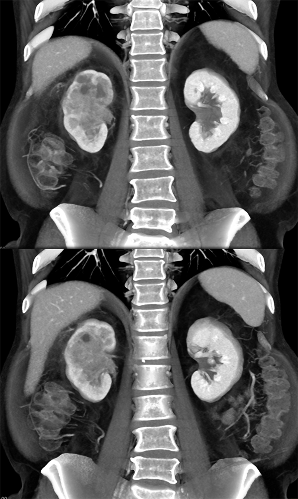 Transitional Cell Carcinoma of the Kidneys