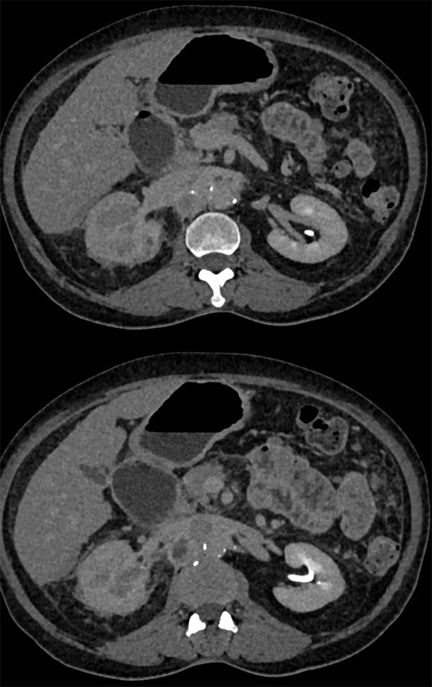 Transitional Cell Carcinoma of the Kidneys