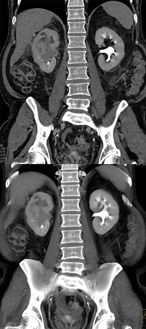 Transitional Cell Carcinoma of the Kidneys