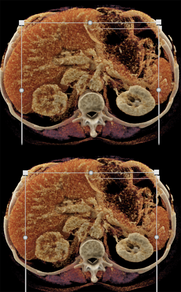 Transitional Cell Carcinoma of the Kidneys