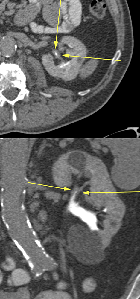 Urothelial thickening