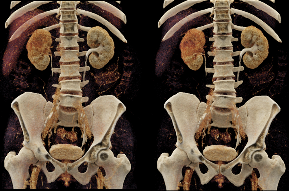 Transitional Cell Carcinoma of the Kidneys