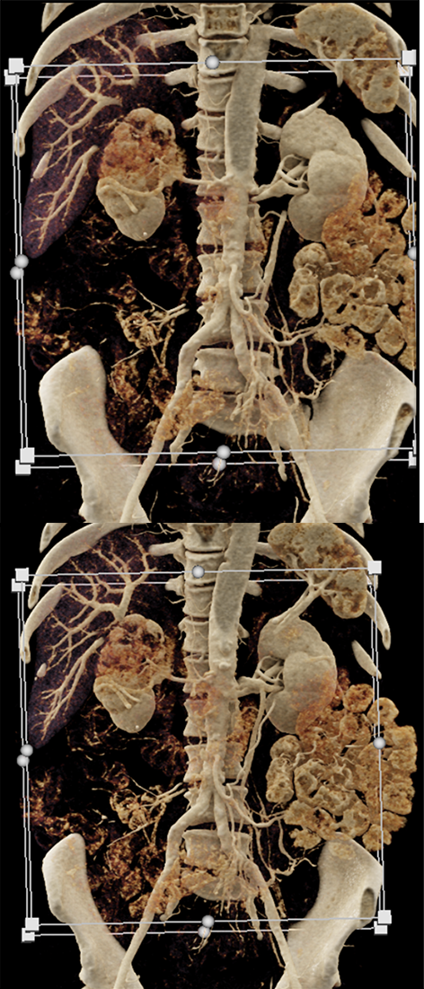 Transitional Cell Carcinoma of the Kidneys