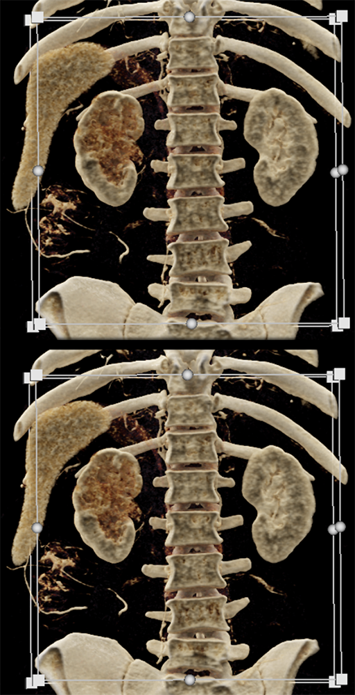 Transitional Cell Carcinoma of the Kidneys