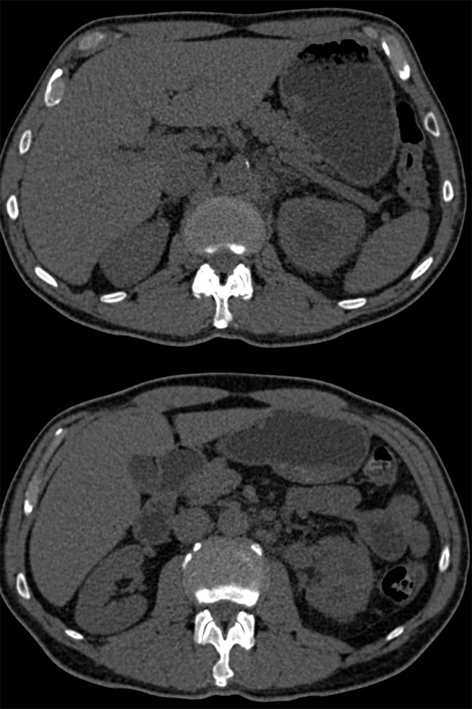 TCC of the Left Renal Pelvis