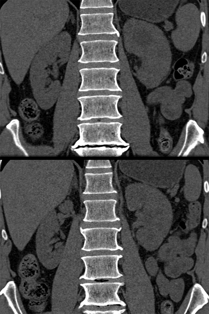 Transitional Cell Carcinoma of the Kidneys