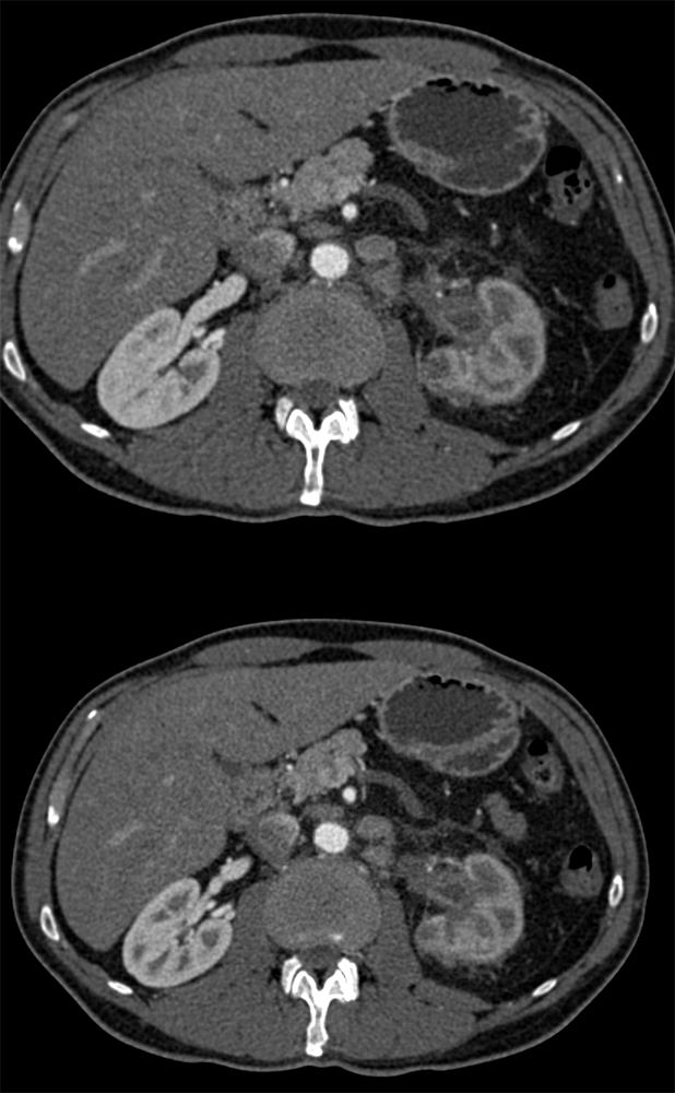 Transitional Cell Carcinoma of the Kidneys