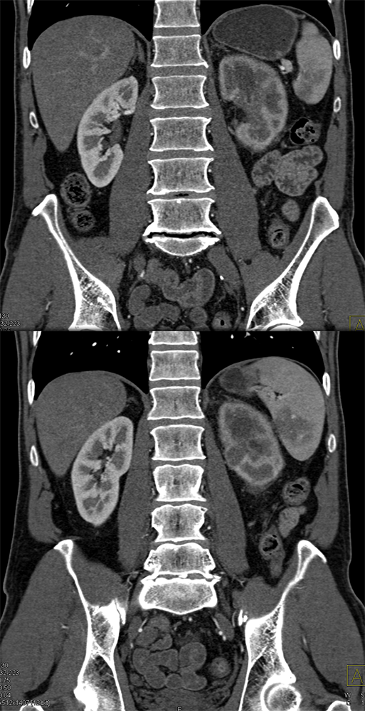 Transitional Cell Carcinoma of the Kidneys