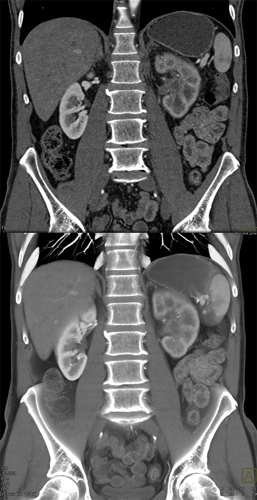 Transitional Cell Carcinoma of the Kidneys