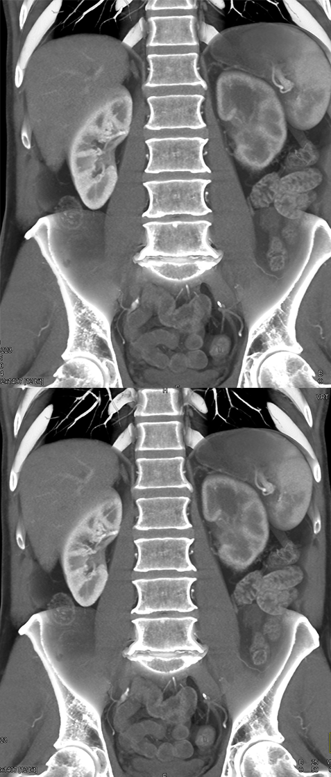 Transitional Cell Carcinoma of the Kidneys