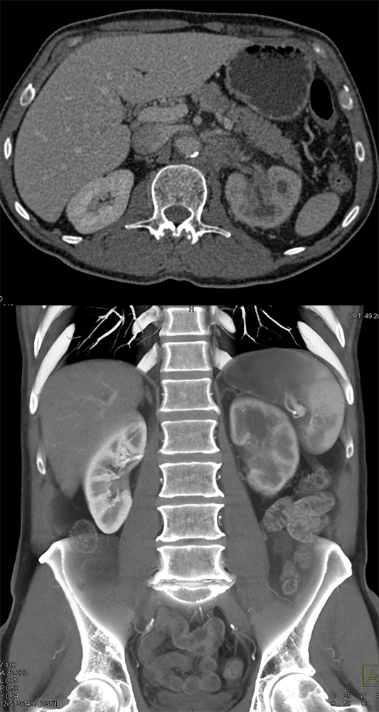 Transitional Cell Carcinoma of the Kidneys