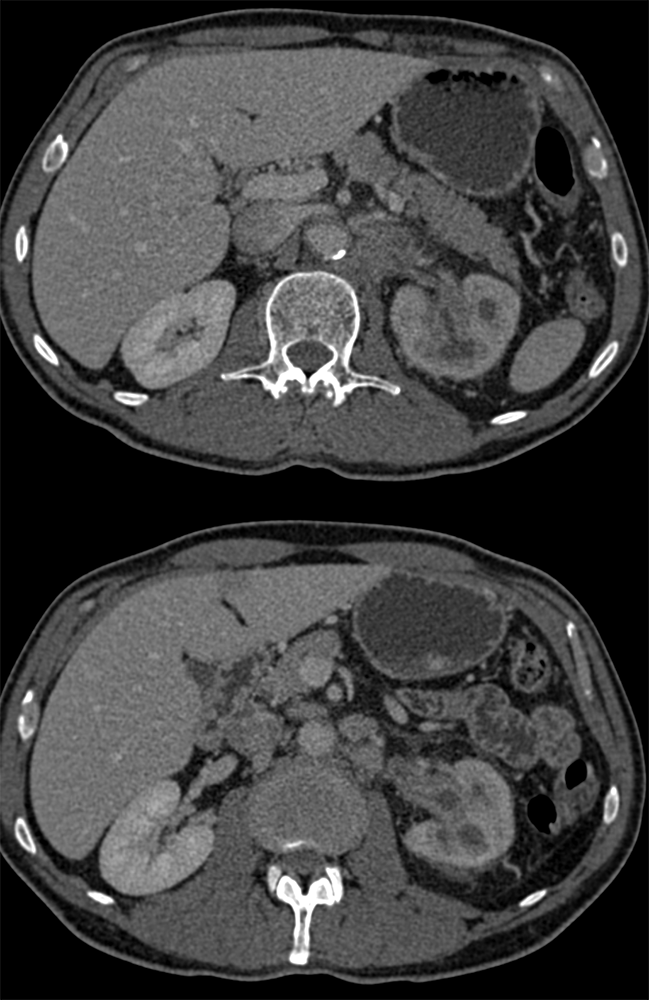 Transitional Cell Carcinoma of the Kidneys