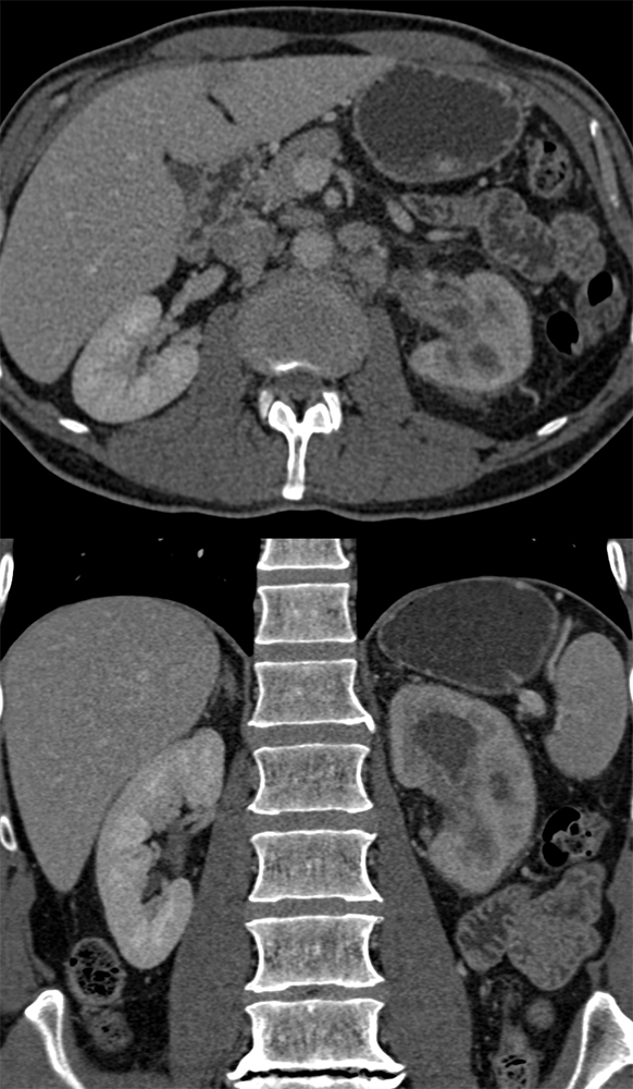 Transitional Cell Carcinoma of the Kidneys